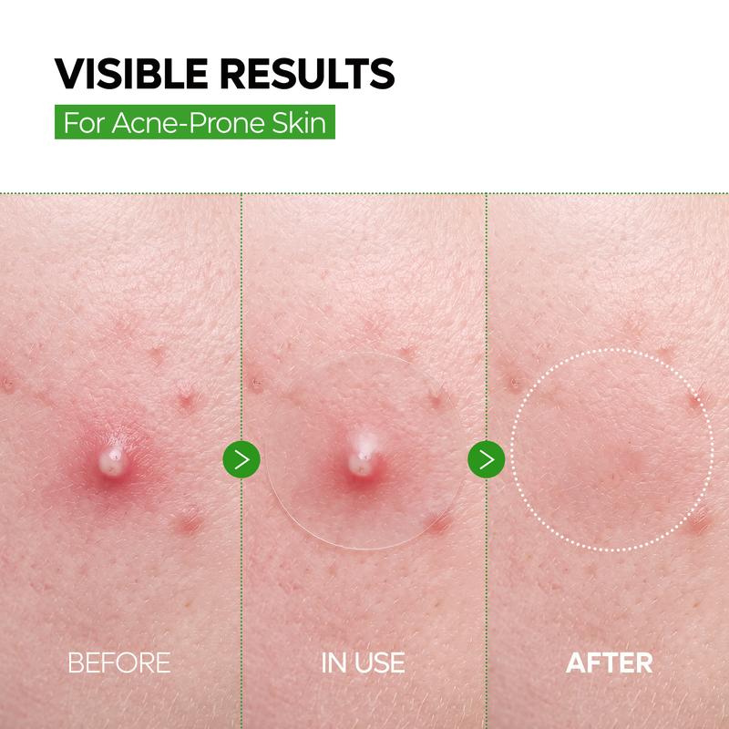 INVISO™ — Invisible Acne & Dark Spot Patch Duo